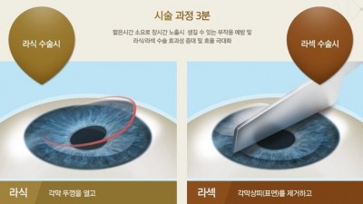 내가 안경 쓴 의사한테 라섹수술을 받은 이유